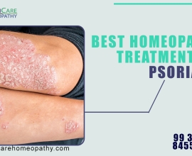 Types of psoriasis